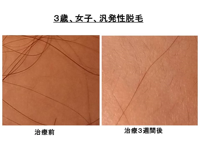 円形脱毛症　病院""